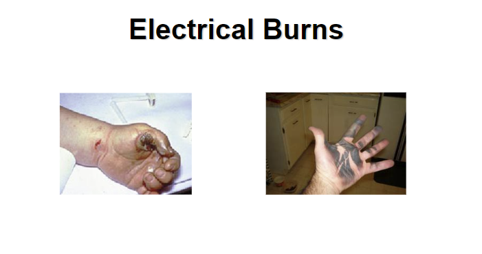 hazards for electrical burns